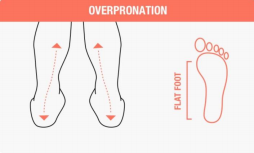 الانحناء الشديد كيف تختار الحذاء المناسب لشكل قدميك؟  
