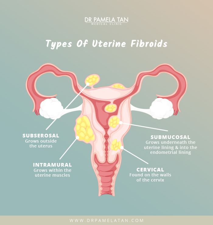 Types-of-uterine-fibroids