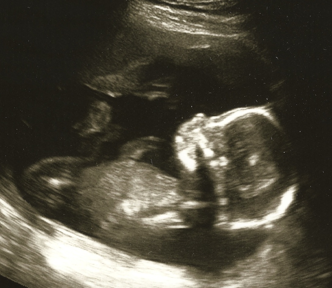 20 week ultrasound 3_cropped_resized2.jpg