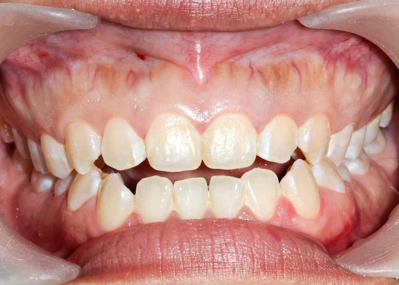The anterior open bite is caused by a patient wearing a nightguard covering only the front teeth.