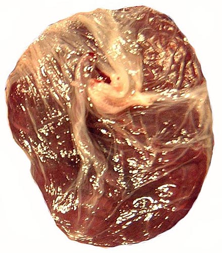 Placental disk after its detachment