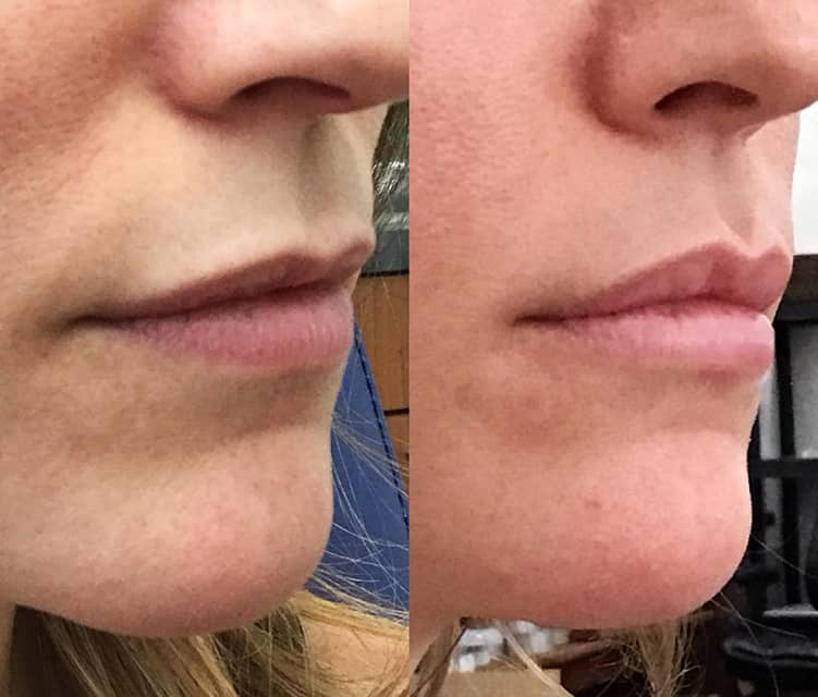 Vestavia Family Dentistry lip flip before and after 