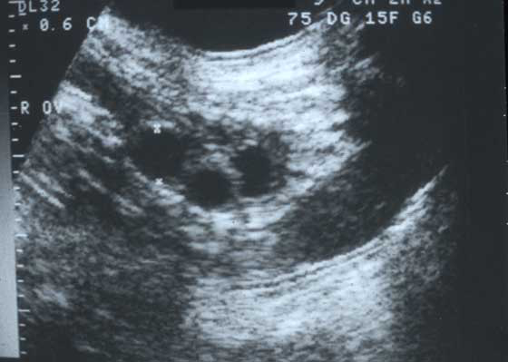 Transabdominal ultrasonogram of a bitch showing an ovary with three anechoic, large follicles at 1 day before ovulation