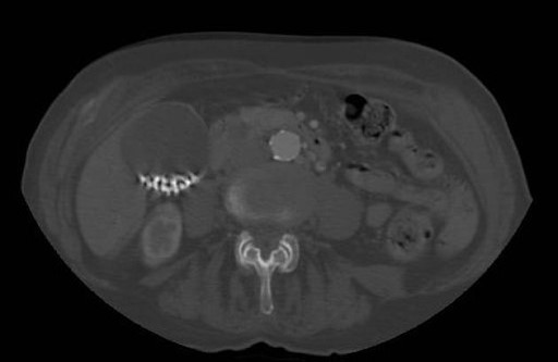 Tomografia computadorizada de abdome mostrando cálculos biliares calcificados na vesícula biliar. (Colecistopatia calculosa)