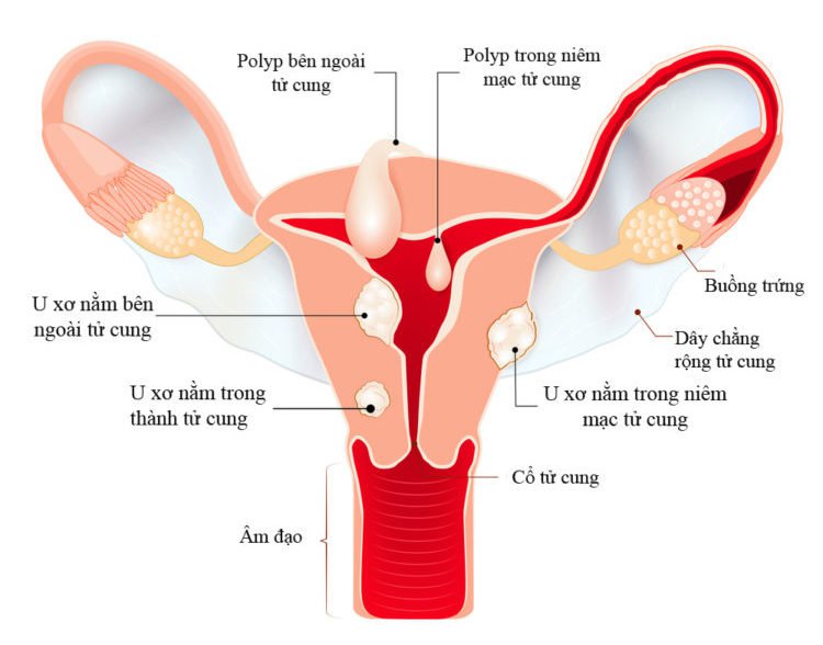 Hình ảnh u xơ tử cung