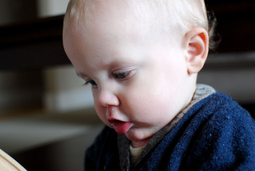 Dairy Rash