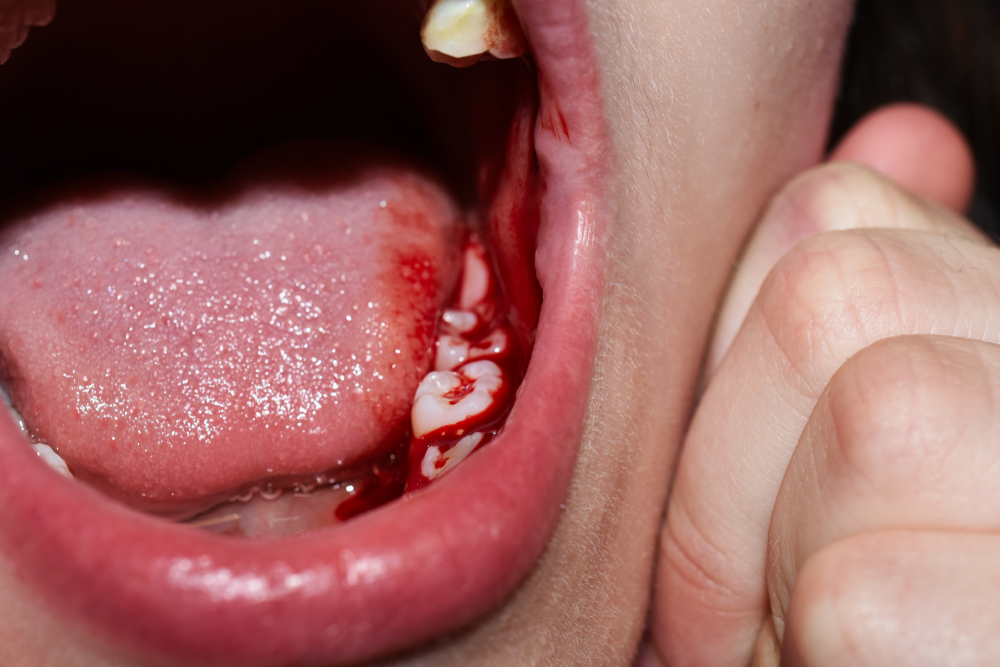 Bleeding in Tooth