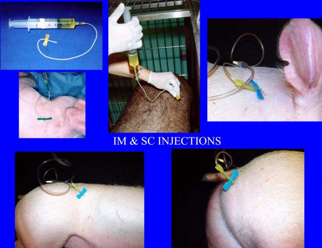 Intramuscular (IM) and subcutaneous injections (SC) injection sites using a butterfly catheter.
