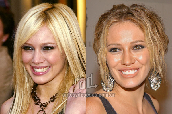 Hilary Duff y sus nuevos dientes, antes y despues