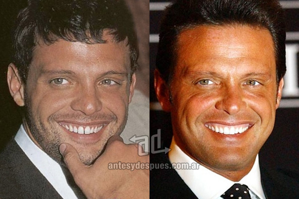 Luis Miguel y sus nuevos dientes, antes y despues