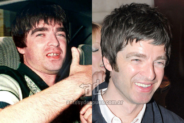 Noel Gallagher y sus nuevos dientes, antes y despues