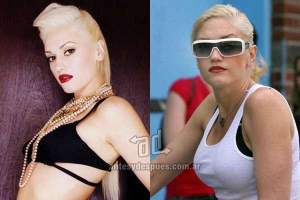 Gwen Stefani breast augmentation