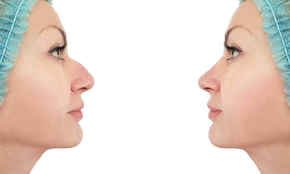 Nâng mũi cấu trúc sụn tự thân hay bọc sụn nhân tạo sẽ tốt hơn?