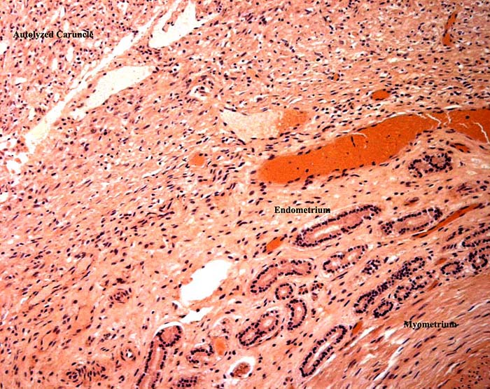 Uterine wall with endometrial glands and autolyzed caruncle