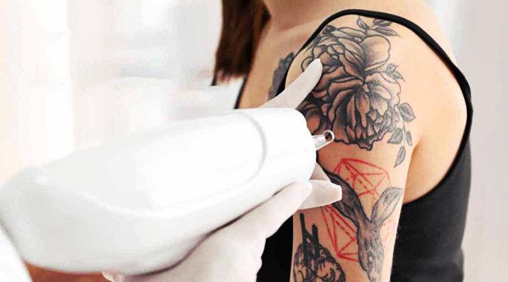 How Laser Hair Removal Affects Tattoos | Fresh Skin Canvas