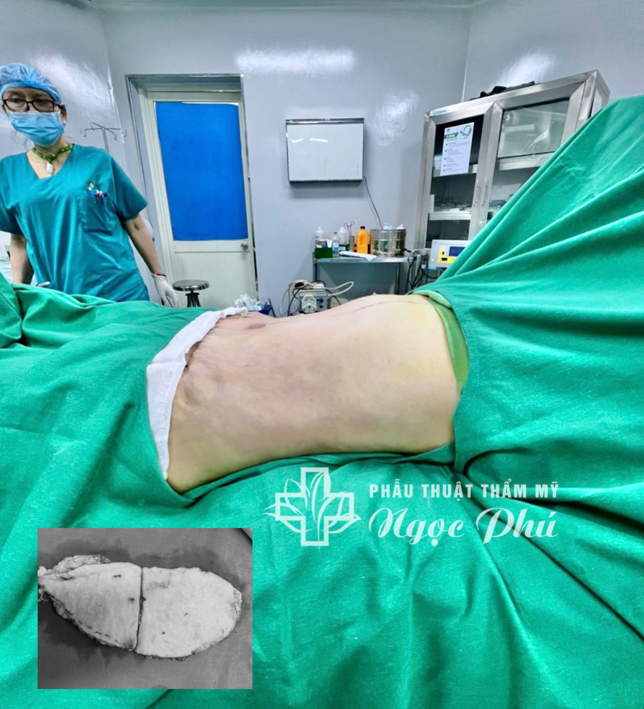 Hút mỡ bụng là một thủ thuật phẫu thuật thẩm mỹ phổ biến được thực hiện để loại bỏ mỡ thừa khỏi vùng bụng.