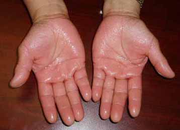 sweaty hands cure