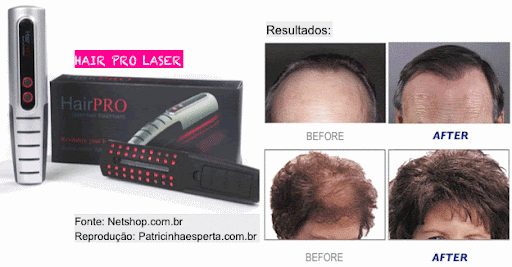 Hair%20Pro%20Laser%20resultados - Hair Laser e Hair Pro Laser - acelere o crescimento de seus cabelos