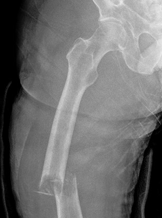 الأشعة السينية لكسر بسبب آفة العظام النقيلي.