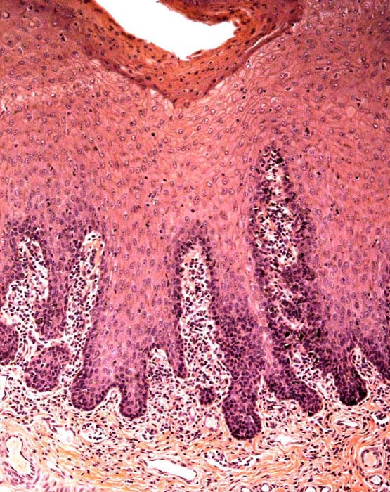 Vaginal epithelium with dense collection of immunocytes