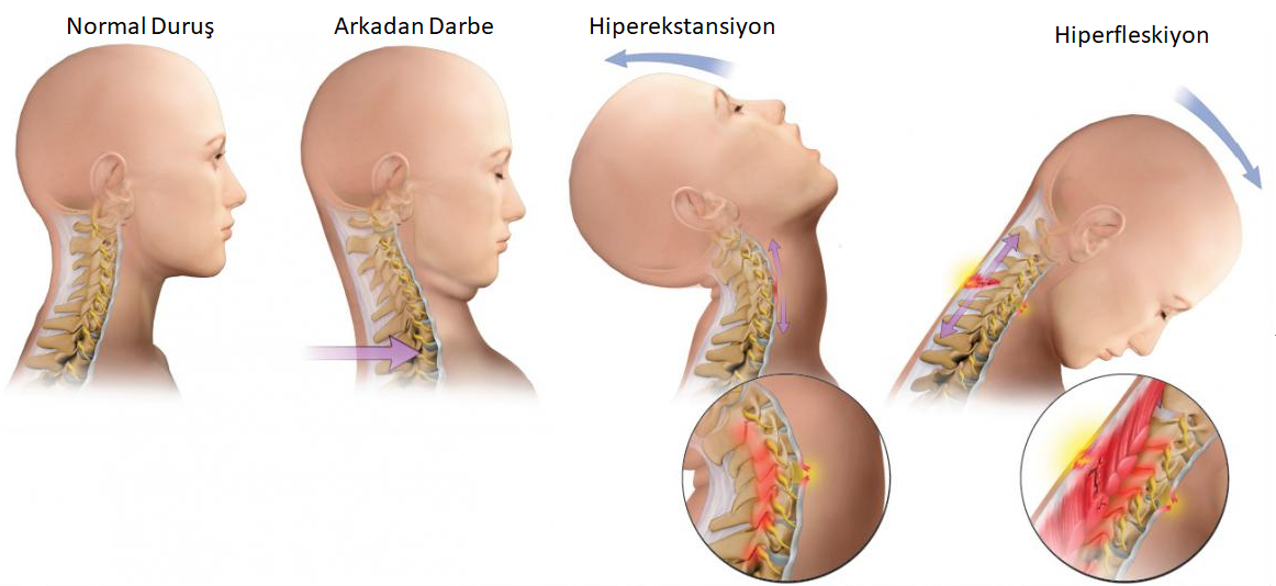 Şekil 2: Boyun yaralanmaları sıradan hafif bir trafik kazasında da olabilir. Kafanın aşırı ani hiperekstansiyonu ardından hiperfleksiyonu sonucu disklerde birden fazlasında yırtılma vey incinmesi meydana gelebilir. (Kaynak)