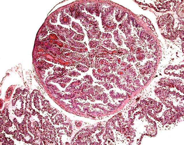 'Areola' on the surface of the placenta.