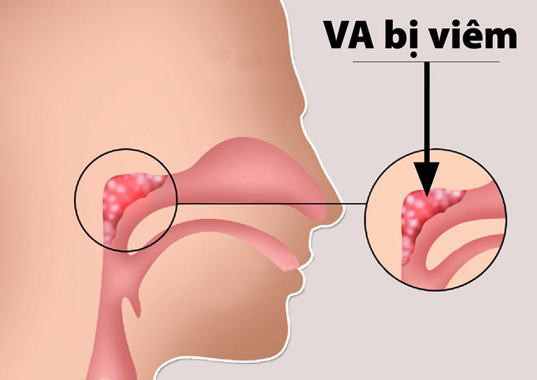 Viêm V.A ở trẻ