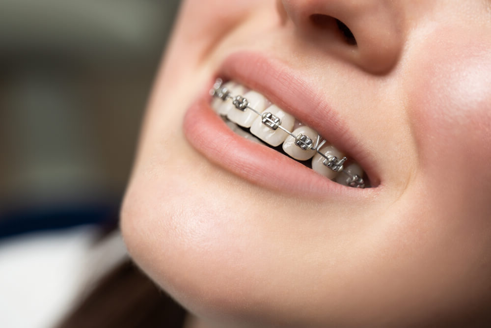 orthodontist in Newmarket 