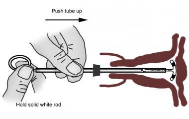 Advancing the insertion tubing to the fundus, wher