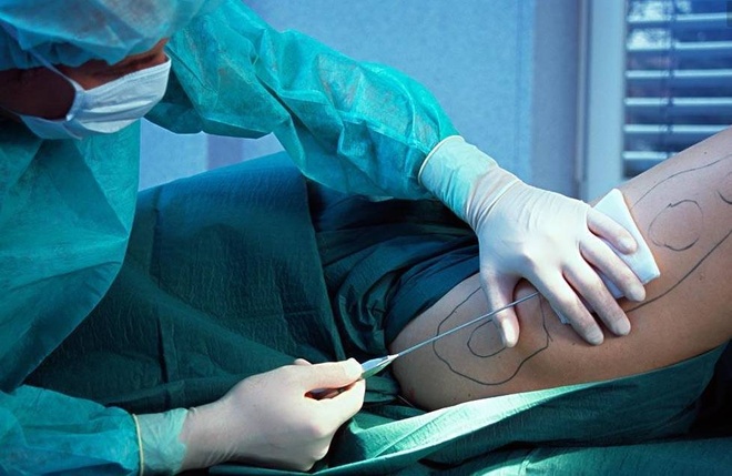 Công nghệ hút mỡ tại Thẩm Mỹ Việt Nam được chuyển giao trực tiếp từ Hàn Quốc, được kiểm định khắt khe và đạt chứng nhận an toàn cũng như tính hiệu quả cao từ các tổ chức Y tế trên thế giới
