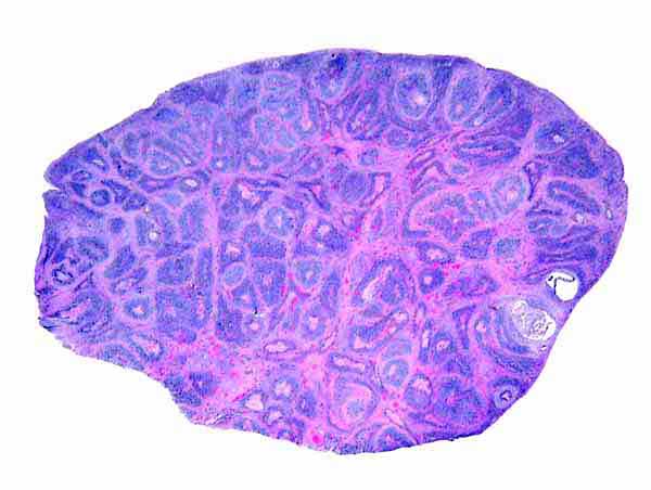 Section of one ovary to show the extensive follicular luteinization