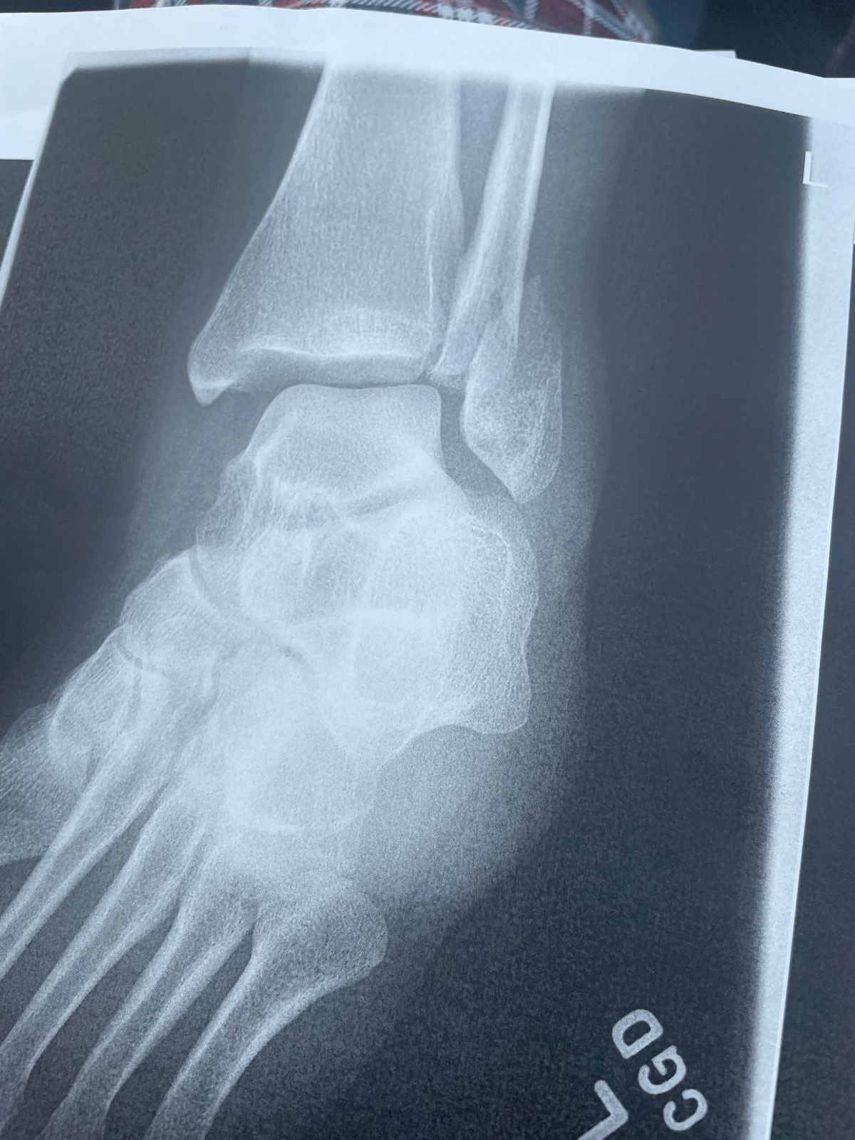 Initial X ray showing left distal fibula fracture