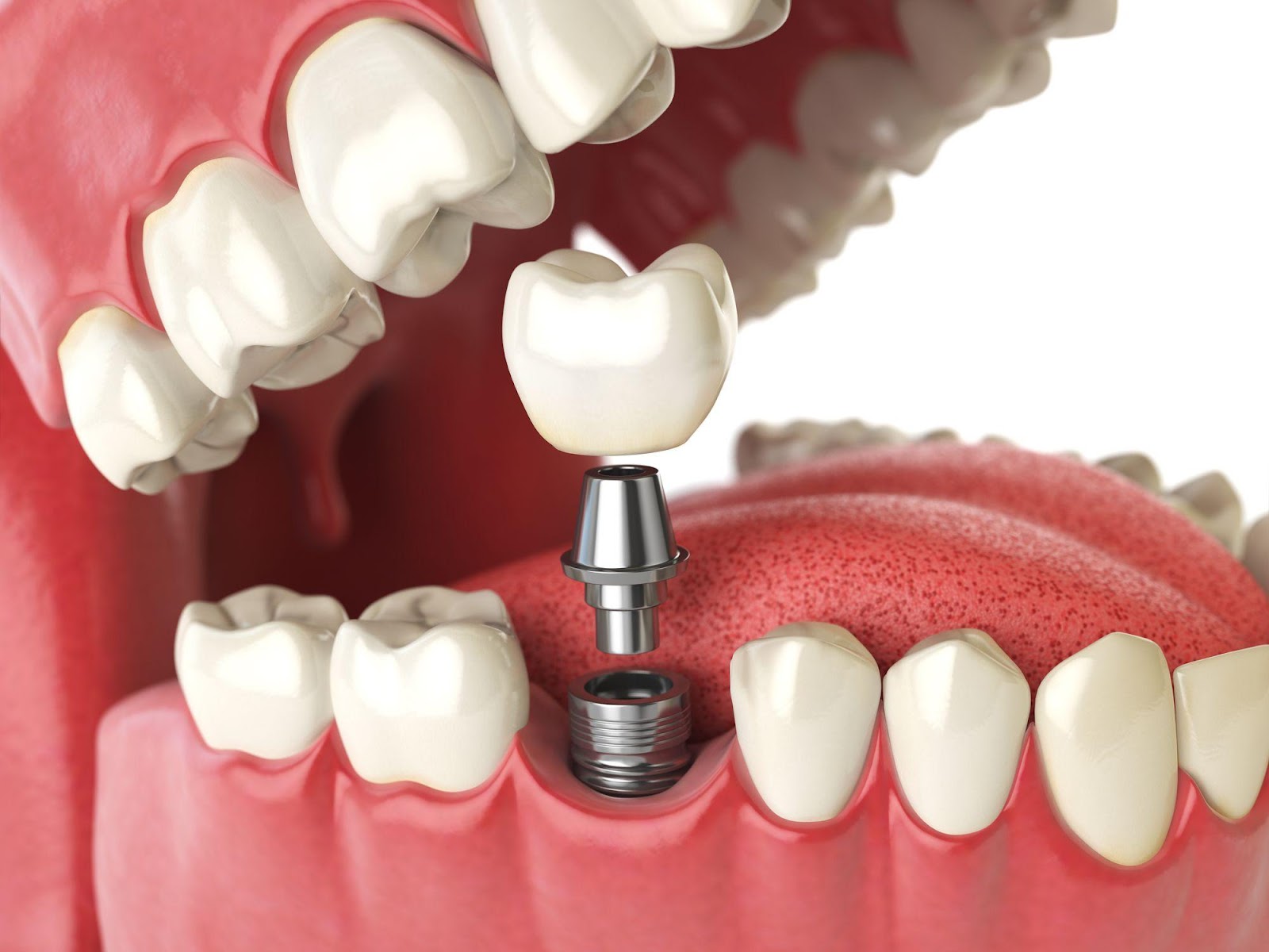 Image result for Dental Implants