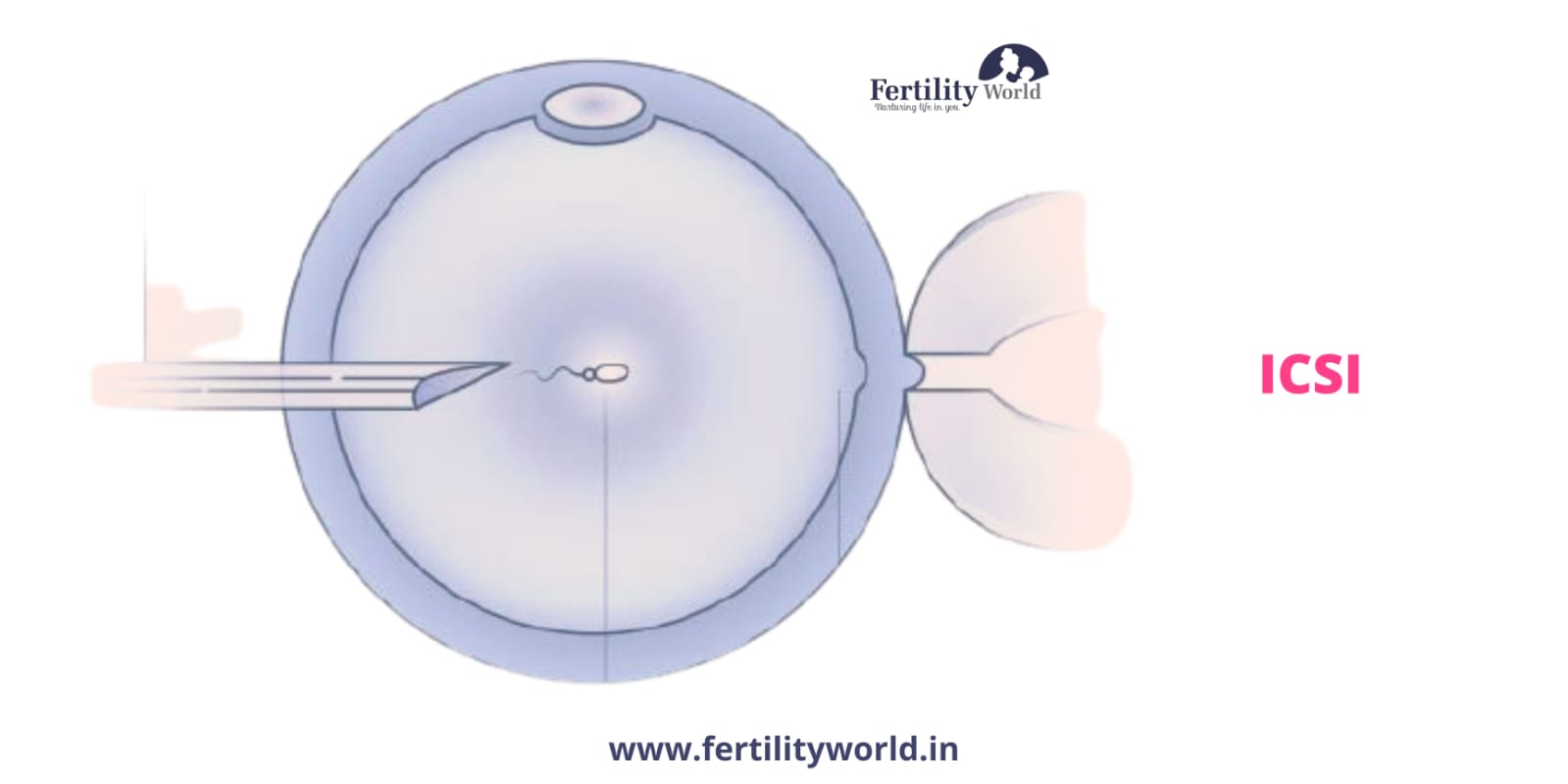 Cost of Intracytoplasmic sperm injection (ICSI) in Jodhpur