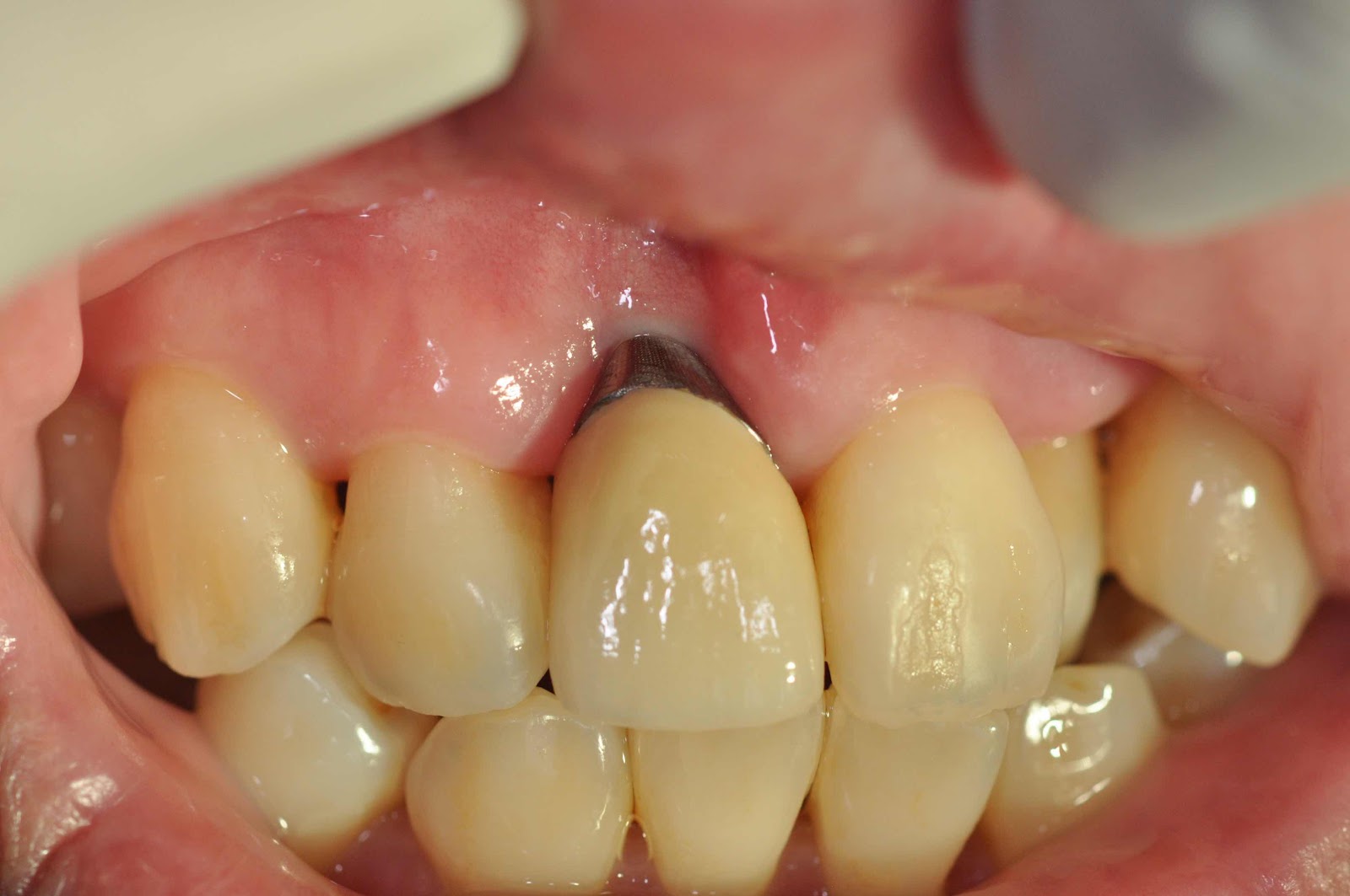 牙齦萎縮露出植體基座