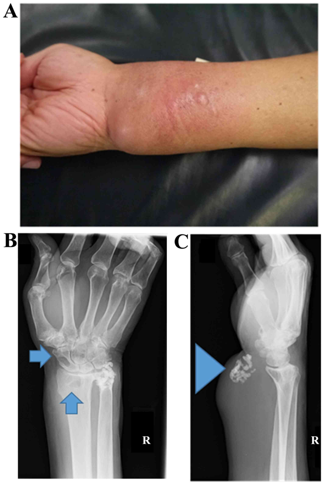 Sarcoma dei tessuti molli