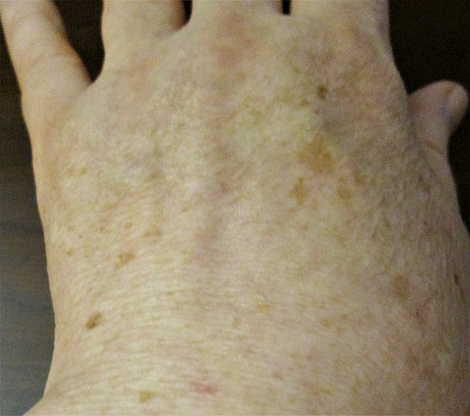 A picture showing age spots or liver spots