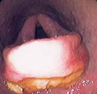 Acute epiglottitis in a 2 year old Standardbred racehorse. The entire epiglottis and particularly the subepiglottic tissue, is swollen, inflamed and ulcerated. The apex, lateral borders and the dorsal surface of the epiglottis were visible, differentiating this condition from an aryepiglottic fold entrapment. The condition was successfully treated medically and the horse resumed racing.