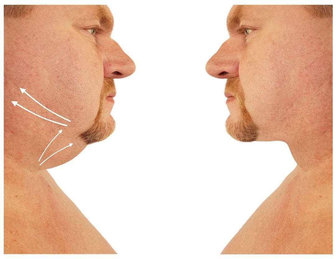 



Comment pouvez-vous réduire la graisse sur le visage?  (4 façons simples)