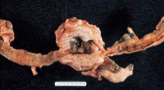 Loop of bowel with large carcinoma. Note the ulcerated luminal surface which caused chronic hemorrhage and secondary iron deficiency anemia. 
