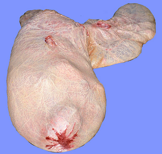 Placental with fetus showing the 'cervical star', site of future rupture of membranes