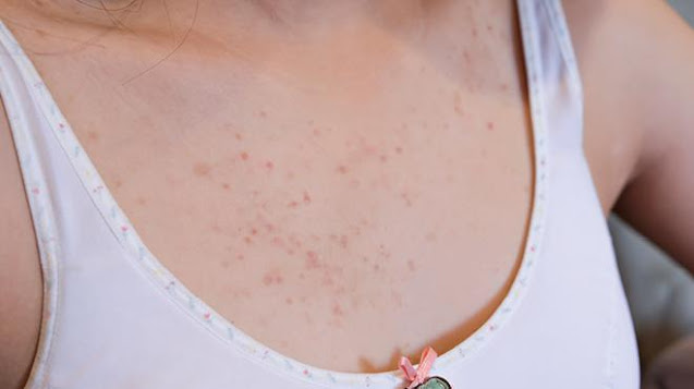 Chest acne solution at Da Vinci Clinic