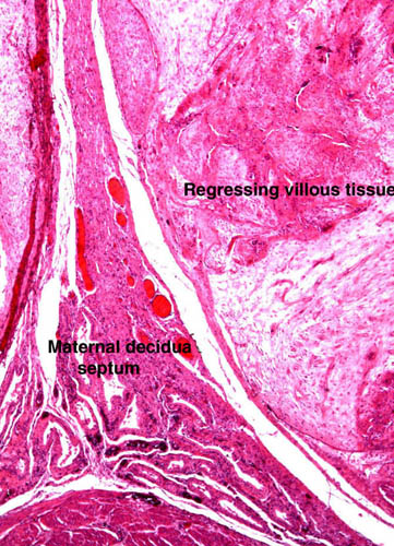 A septum of decidual tissue protrudes between two regressing lobules of labyrinth