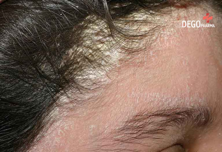  Vảy nến da đầu có thể lan ra vùng rìa trán của người bệnh
