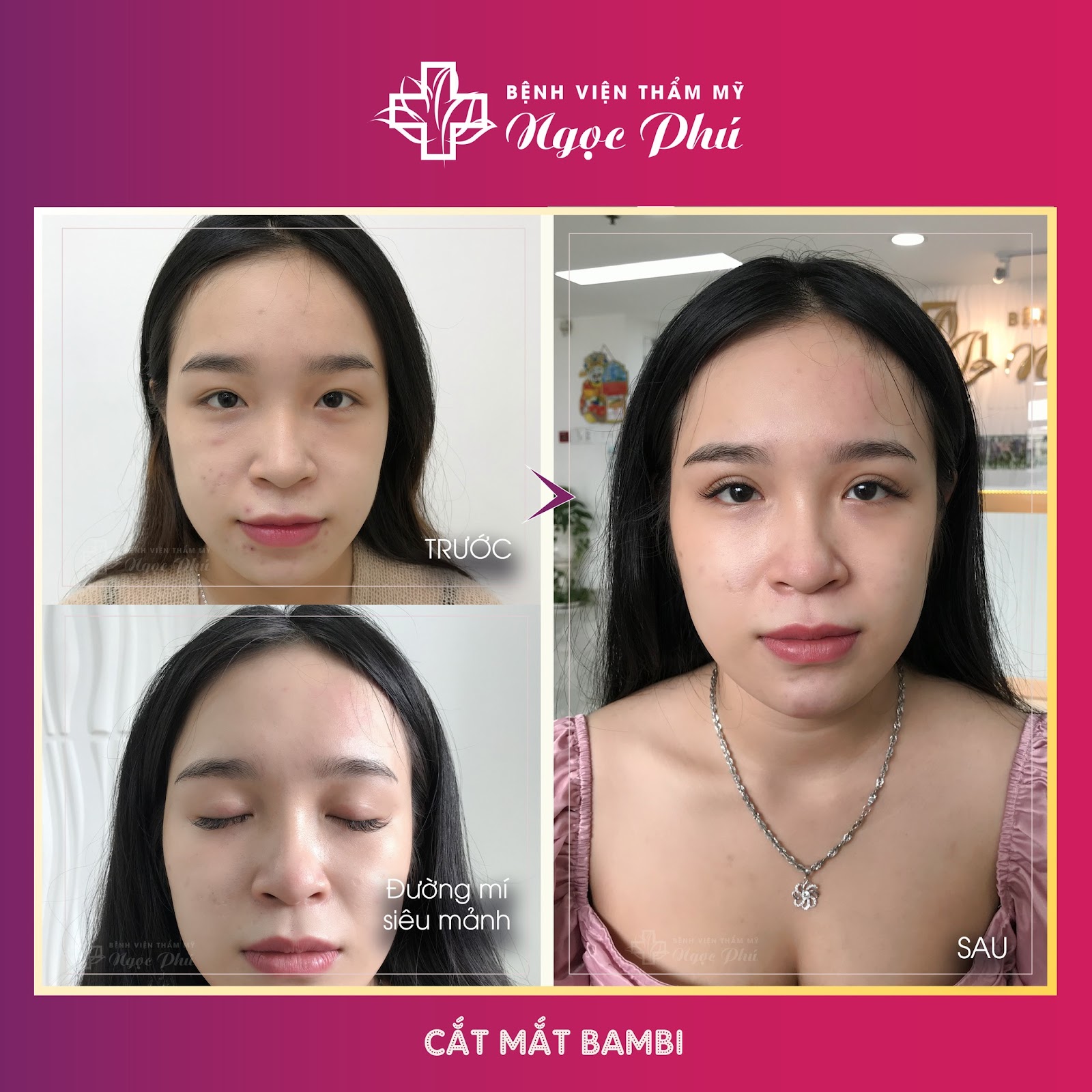 Chị T.D.L (30 tuổi - Bình Thạnh) - Khách hàng thực tế tại Bệnh viện Thẩm mỹ Ngọc Phú chia sẻ về kinh nghiệm cắt mắt 2 mí 