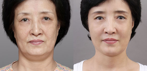 Căng da mặt bằng chỉ collagen đánh tan nỗi lo lão hóa, nhăn nheo mà không đụng chạm dao kéo, được hội chị em và cả đấng mày râu vô cùng yêu thích
