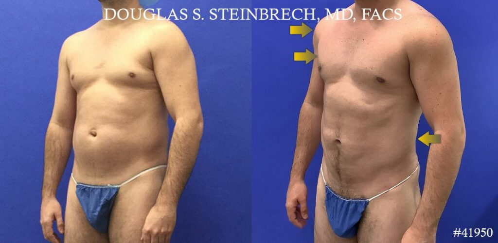 male liposuction results new york