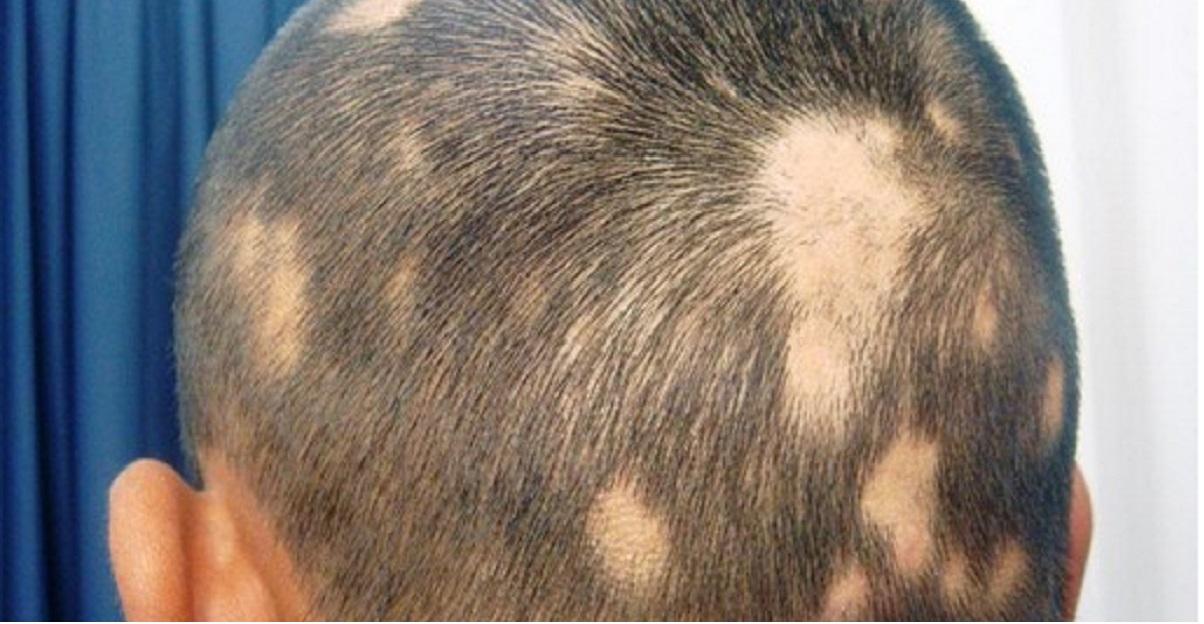 man with alopecia areata, patchy, hair loss