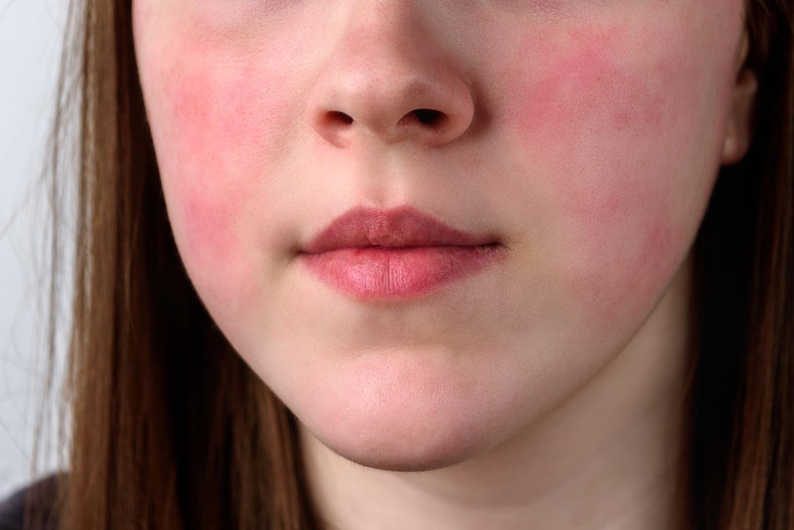 Roșeața pielii: Alergia sau altă afecțiune?