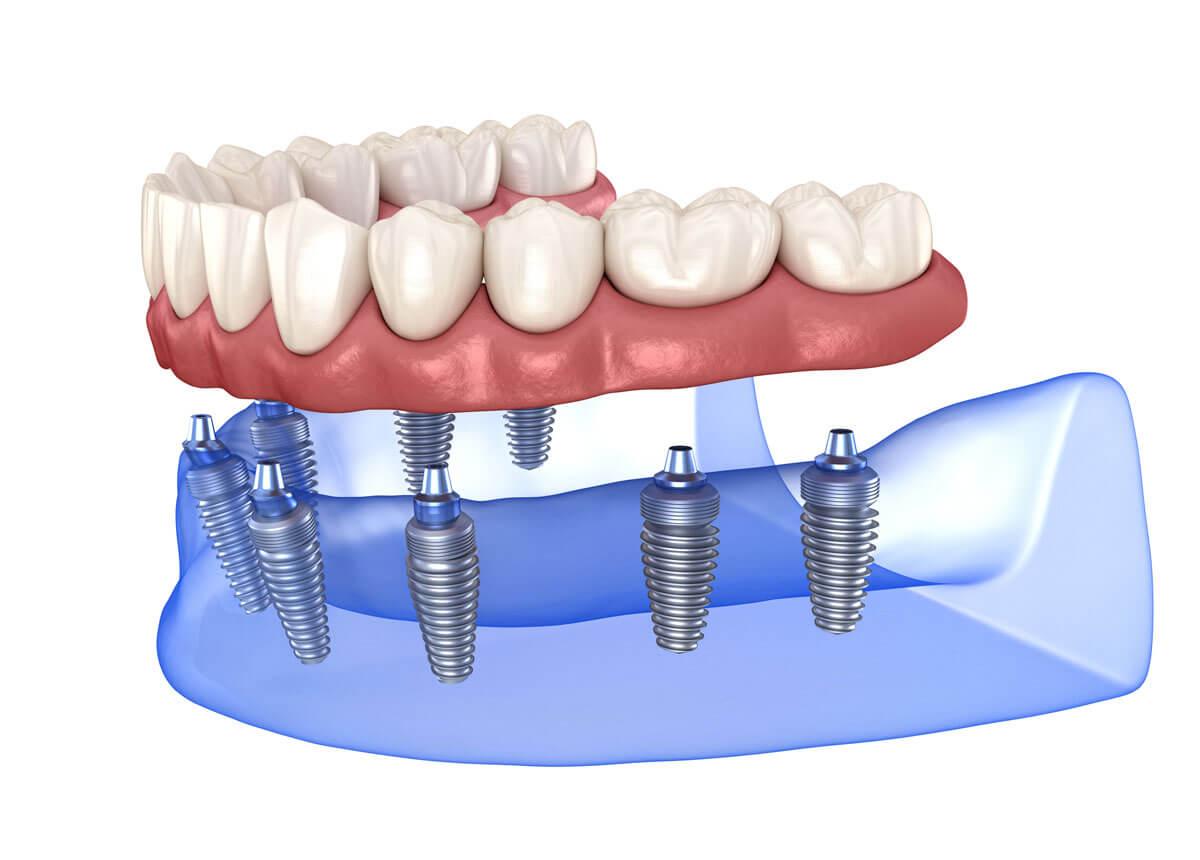 teeth implants in Vancouver